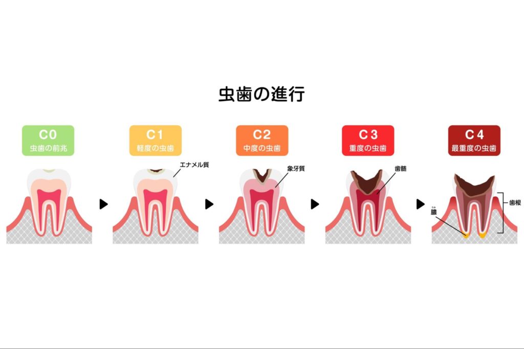 虫歯の進行段階のイラスト