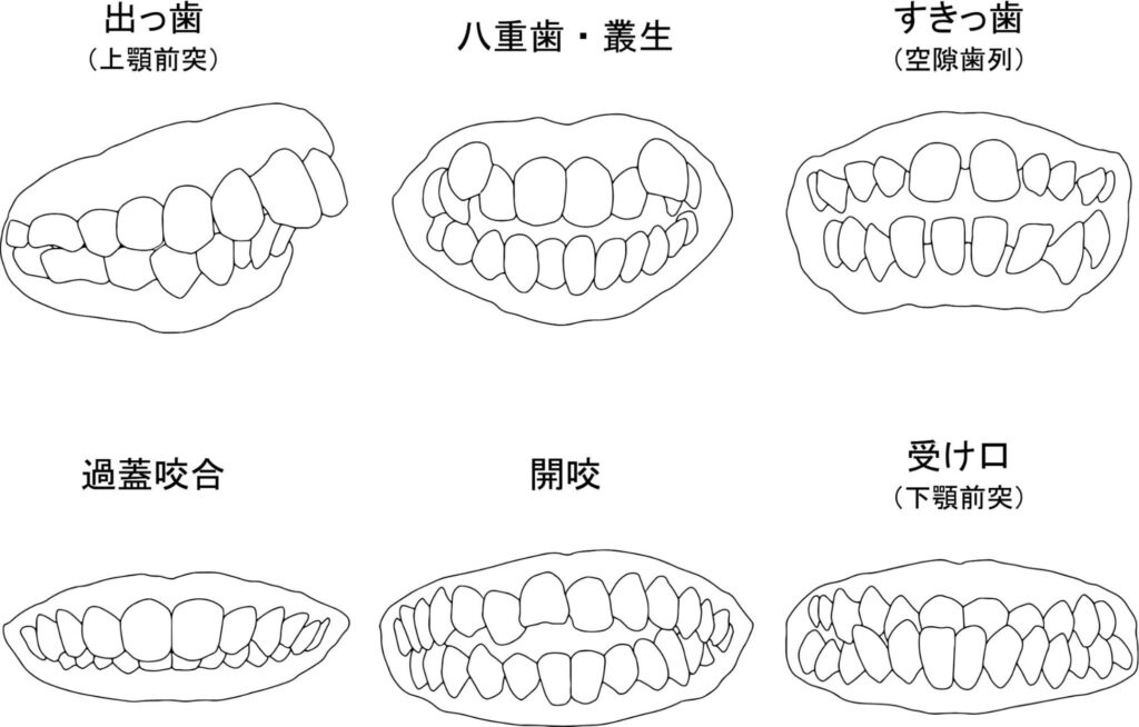 悪い歯並びの種類